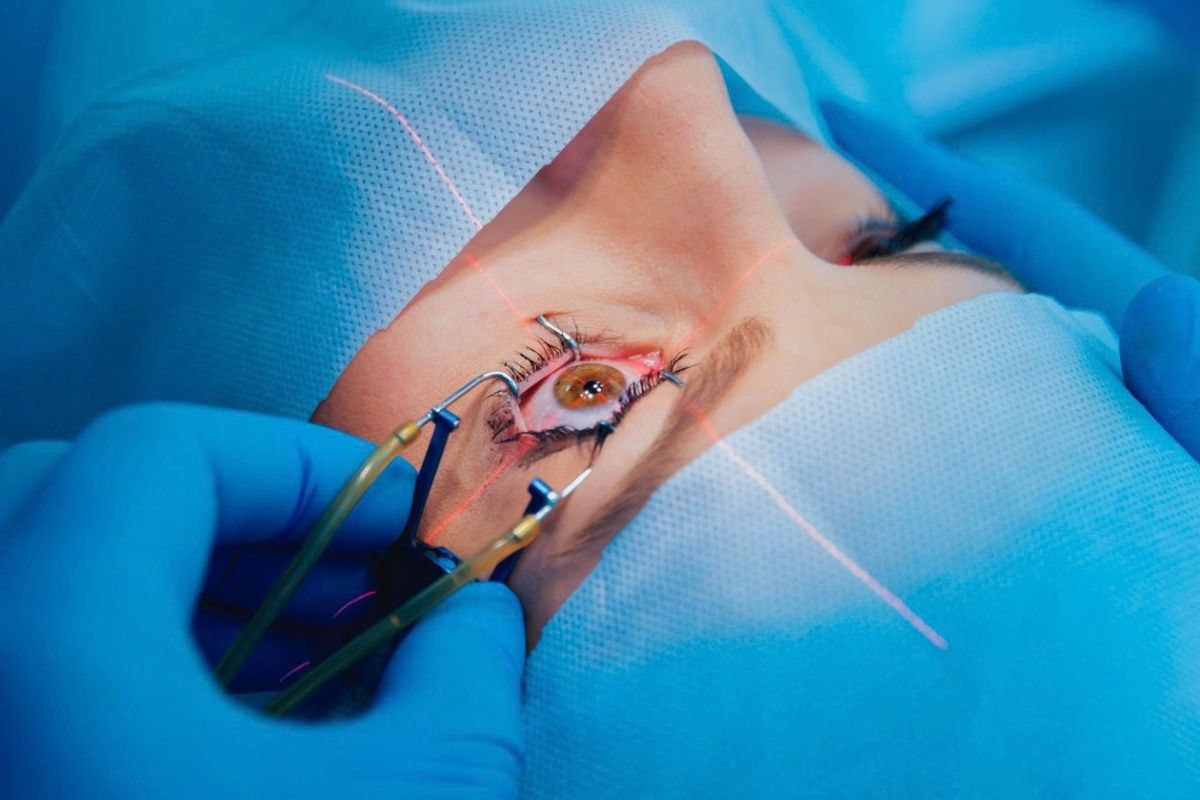 Procedimiento de cirugía láser de ojos con guía láser sobre la córnea del paciente